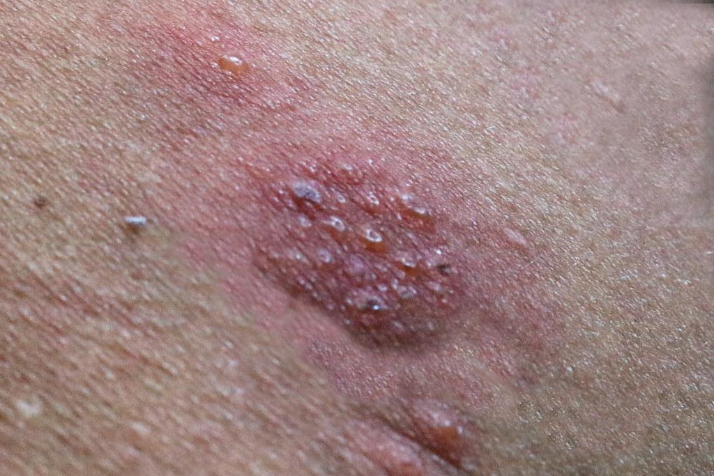 maculopapular rash hiv