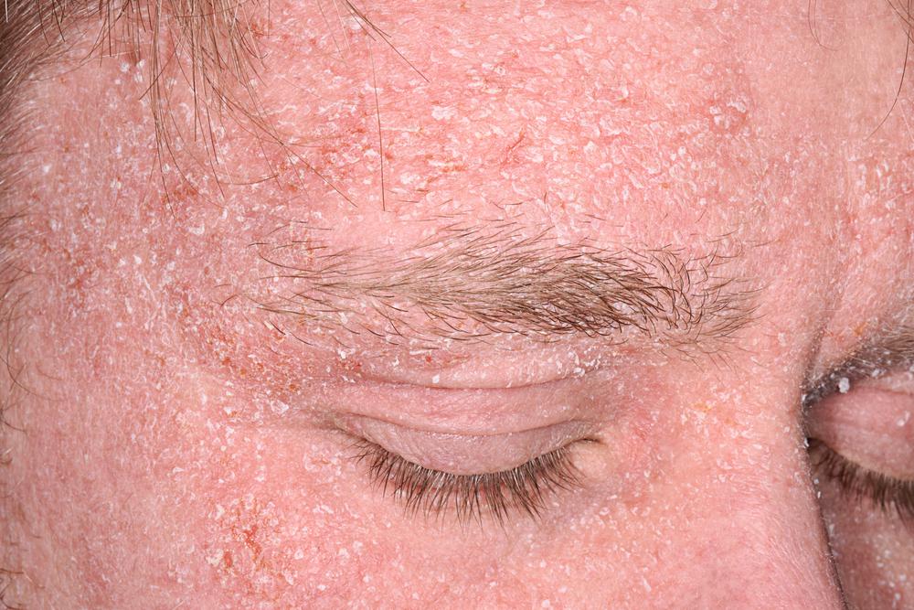 Seborrheic Dermatitis Red Patches On Face Treatment S