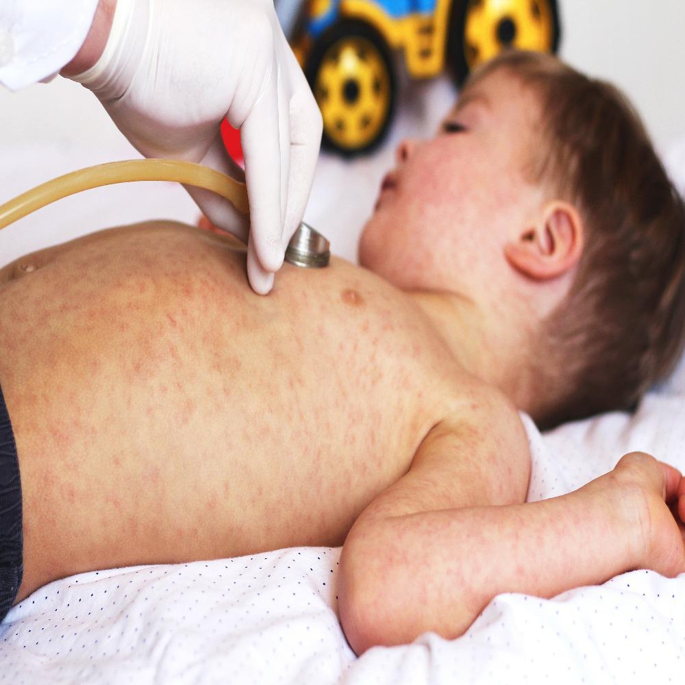 measles-the-dreaded-disease-family-medical-practice